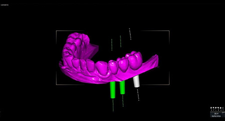 Owandy I-Max Touch 3D – Конусно-лучевой томограф 9х8
