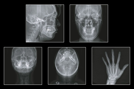 GENORAY Papaya 3D 23x14 - компьютерный томограф с цефалостатом 