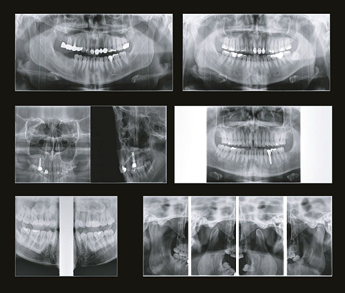 GENORAY Papaya 3D 16x8 - компьютерный томограф